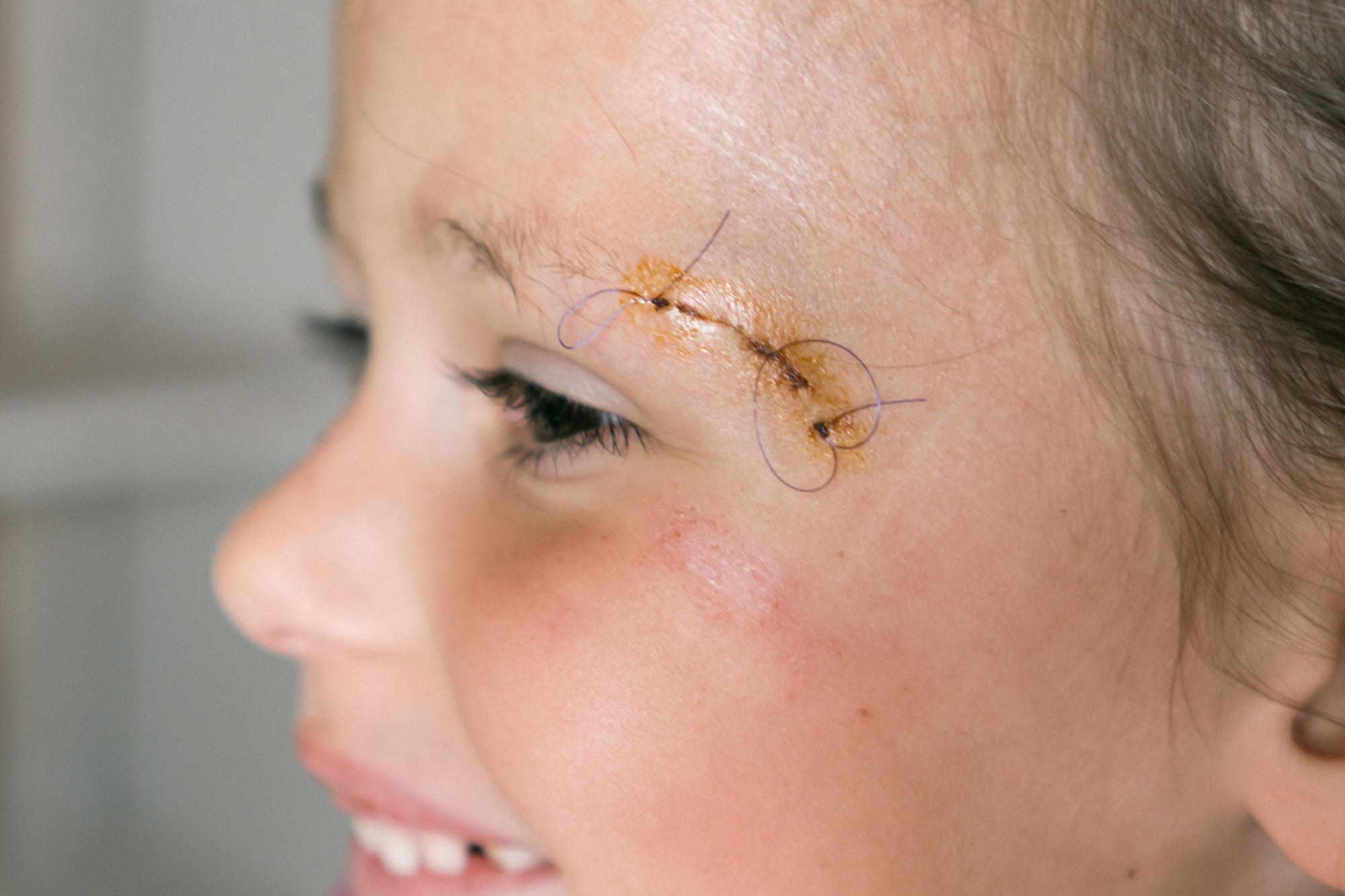 Infection du point de suture résorbable : Les erreurs à ne pas commettre