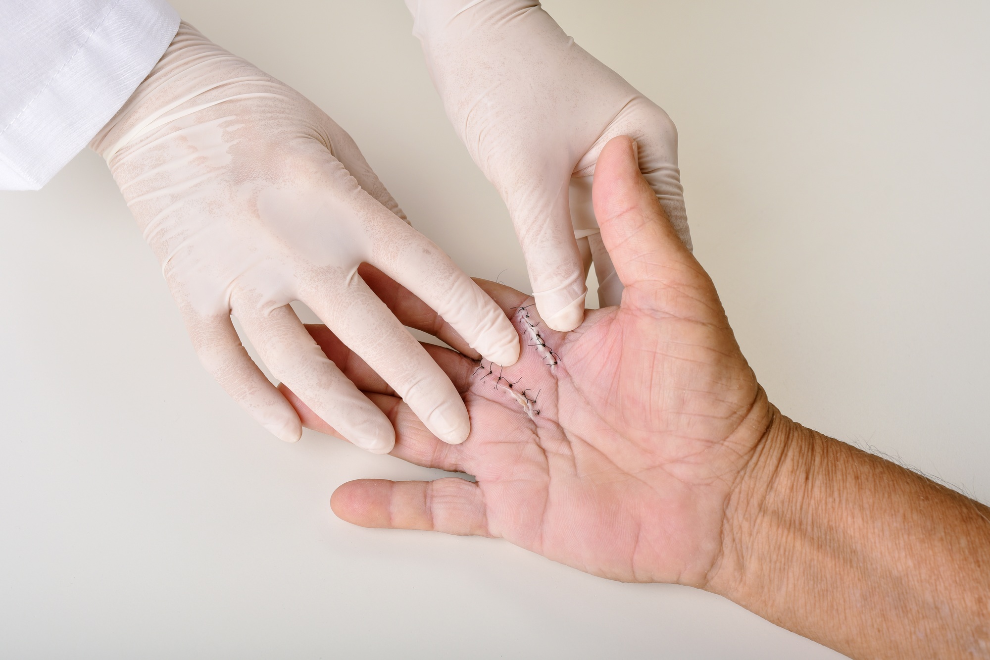 Infection suture